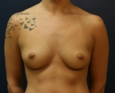 Feel Beautiful - Breast Augmentation San Diego Case 71 - Before Photo